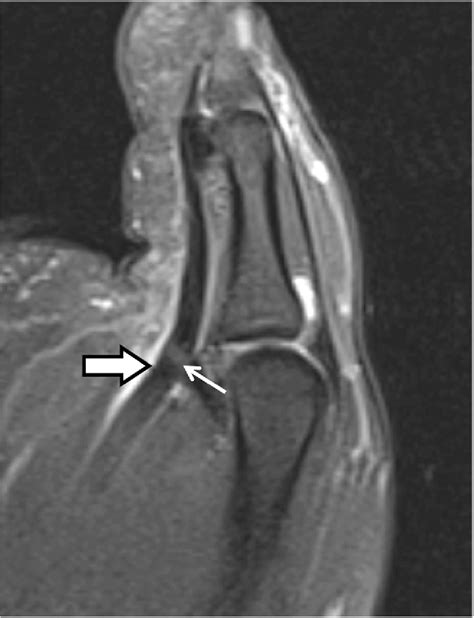 MR imaging findings of trigger thumb - PubMed