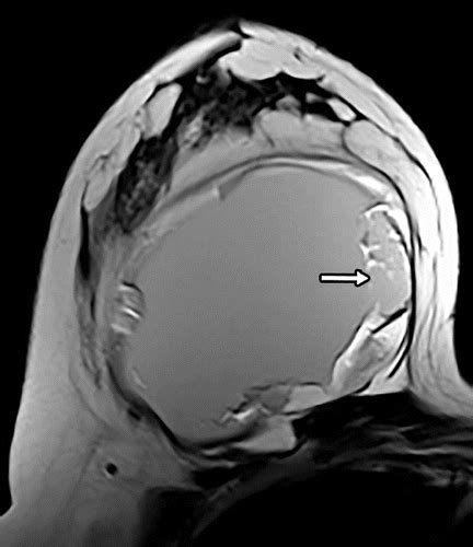 MRI Diagnosis Of Ruptured Silicone Breast Implants