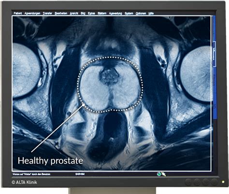 MRI Procedure MULTI-PARAMETRIC Prostate MRI