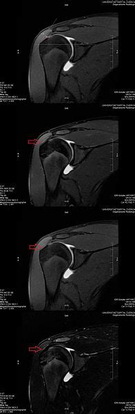 Mri Scan Piercings - wintechmobiles.com