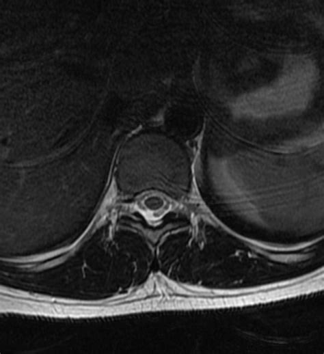 MRI THORACIC SPINE W/WO CONTRAST - Medford Radiology