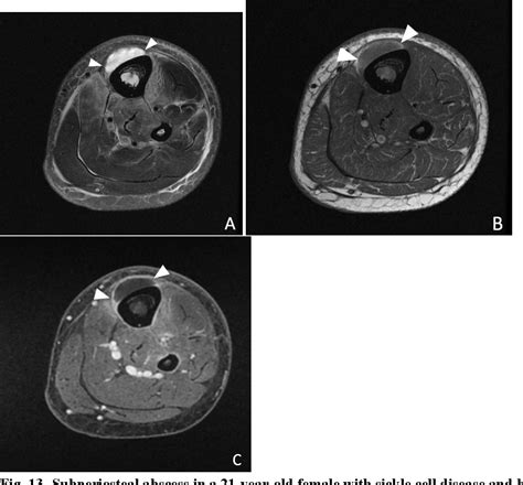 MRI nomenclature for musculoskeletal infection SpringerLink