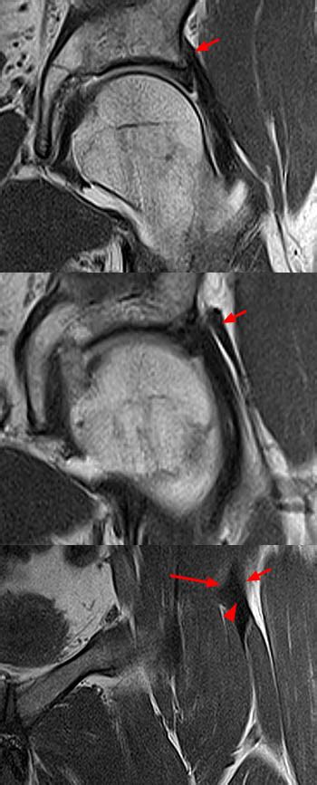 MRI of Rectus Femoris / Quadriceps Injury - Radsource MRI of …