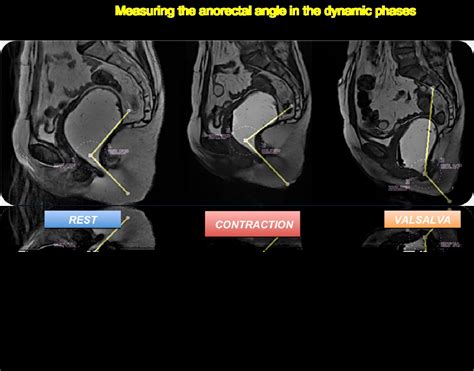 MRI of the Pelvic Floor and MR Defecography