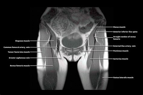 MRI of the Spine and Bony Pelvis Radiology Key