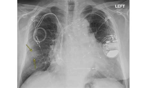 MRI safely performed in patients with pacemakers and …