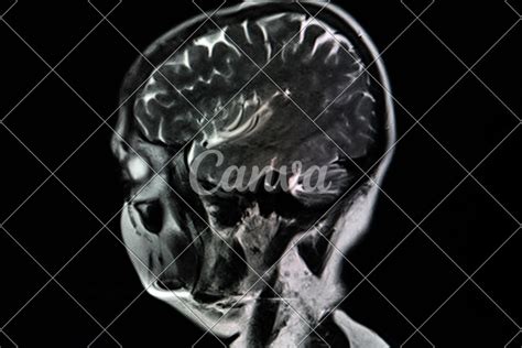 MRI scan of brain - Photos by Canva