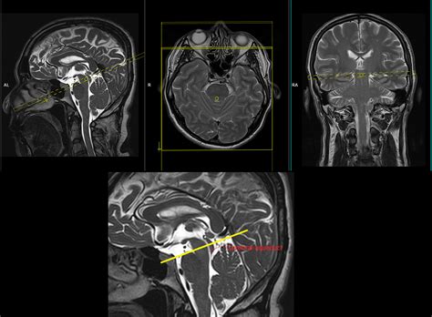 MRI with CSF Flow Cedars Sinai