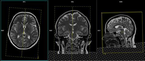 MRV Brain Planning MRV Brain Protocols Indications for MRV Brain Scan