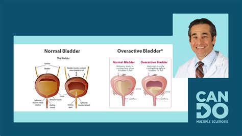 MS bladder issues Types treatment and management