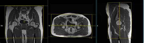 MSK pelvis protocol (MRI) Radiology Reference Article