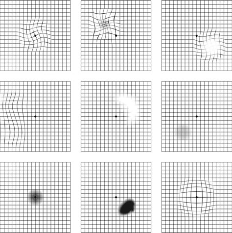 Macular Degeneration Using Amsler Grid