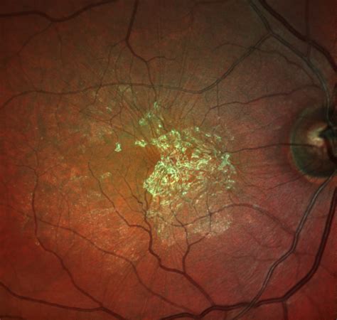 Macular Pucker - VMFHORG