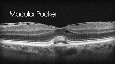 Macular Pucker Symptoms & Diagnosis - Retina Care Consultants …