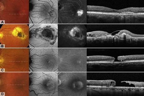 Macular Telangiectasia - EyeWiki