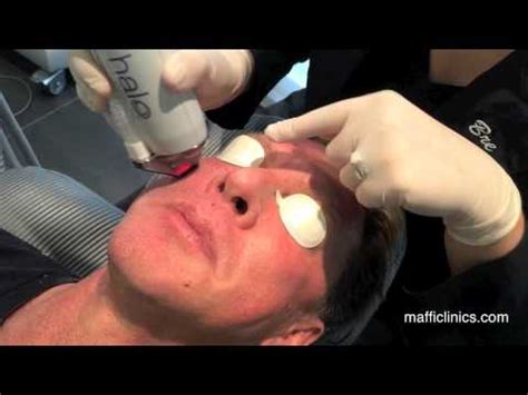 Maffi Clinics: Halo Treatment for Men - YouTube