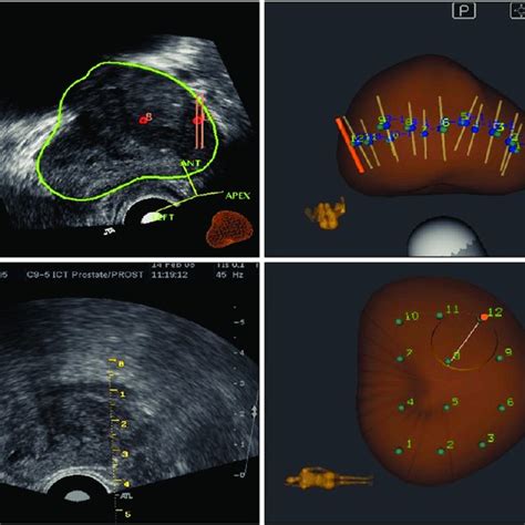 Magnetic Resonance Imaging with Transrectal Ultrasound …