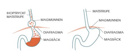 Magsäcken operation