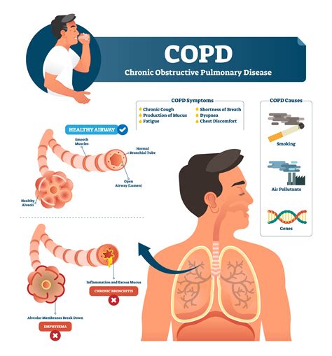 Making COPD a public health priority starts here: understanding the condition