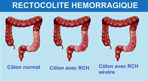 Maladie de crohn et rectocolite hemorragique. - Rac study guide for the basic exam.