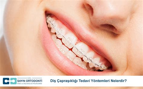 Malatya Diş Çapraşıklığı Tedavisi Doktorları. 