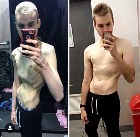 Male Anorexia