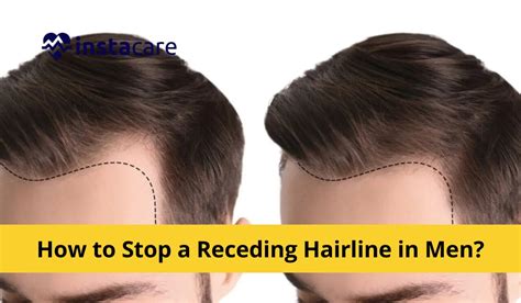 Male Baldness: How To Stop A Receding Hairline