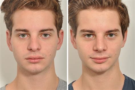 Male Rhinoplasty For Men