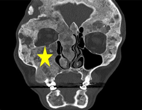 Malignant Transformation in Monostotic Fibrous Dysplasia - PMC