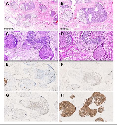 Mammary ductal foam cells: macrophage immunophenotype