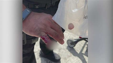 Man bites off part of California officer’s finger during altercation