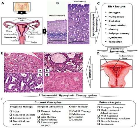 Management of Atypical Endometrial Hyperplasia and …