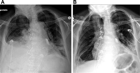 Management of Diaphragm Paralysis and Eventration Thoracic Surgery