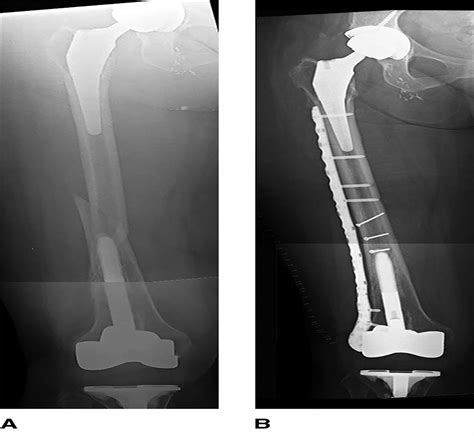 Management of Interprosthetic Femur Fractures : JAAOS