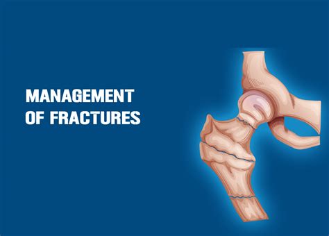 Management of hip fracture - PubMed