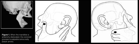 Mandibular Dislocation - WikEM