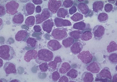 Mantle Cell Lymphoma - PubMed