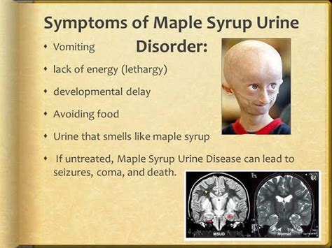 Maple Syrup Urine Disease (MSUD): Symptoms and Treatment