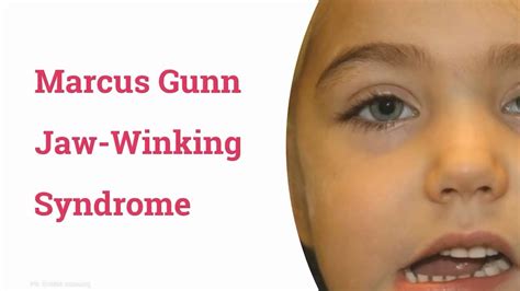 Marcus Gunn Jaw-Winking Syndrome Article - StatPearls