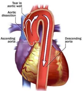 Marfan Syndrome Cardiac Health