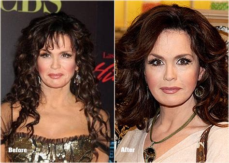 Marie Osmond Plastic Surgery Before and After …