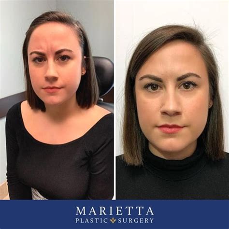 Marietta plastic surgery. 770.425.0118. Get Directions. 149 Towne Lake Pkwy Suite 104. Woodstock, GA 30188. Get Directions. Marietta, Georgia 30060. 770.425.0118. Get Directions. Abdominoplasty before and after patient photos from Atlanta Plastic Surgery Specialist Marietta Plastic Surgery. 