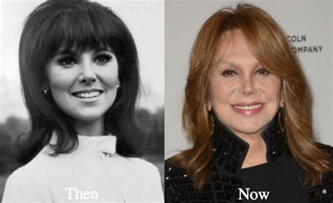 Marlo Thomas Plastic Surgery Rumors. Marlo Thomas has never admitted to having any cosmetic surgery procedures done on her face. However, many fans and experts have speculated that she has undergone several interventions to maintain her youthful appearance. Some of the most common rumors are: Nose Job. One of the earliest changes that fans .... 