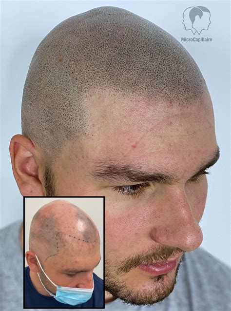 Masquer une perte de cheveux grâce à la micropigmentation de …