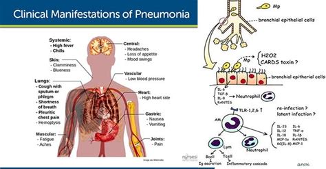 Massachusetts pediatric pneumonia cases going up: ‘No evidence’ it’s tied to mycoplasma