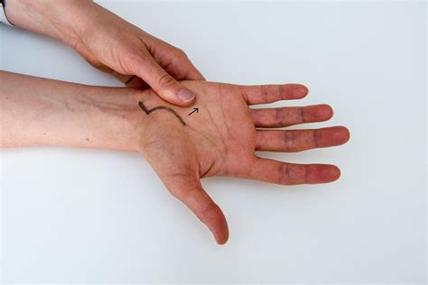 Massera ärr efter operation