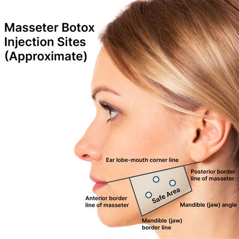 Masseter Botox, also known as Jawline Botox treatment is u