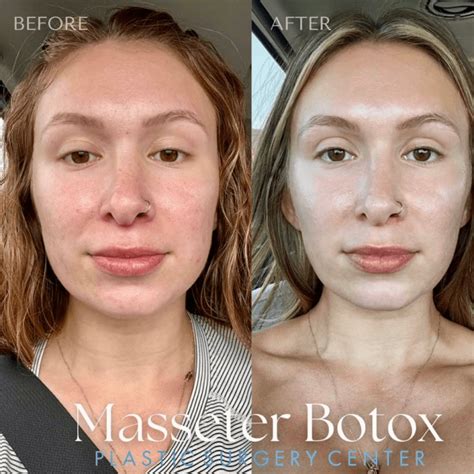 Masseter botox negative effects.  Not everyone is a suitable candidate f...
