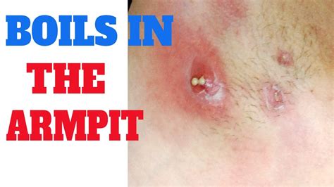 Massive boils bursting videos. Before, during & after the pimple popping process on a #Showoff's nose. Sometimes, a pimple cannot heal underneath the skin on its own. But only pop a pimple... 