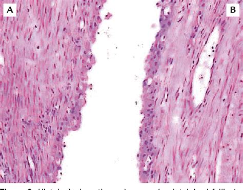 Massive luteinized follicular cyst of pregnancy - PubMed